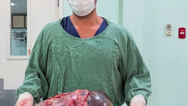 Mulher de Rio das Ostras tem tumor de quase 15kg retirado em cirurgia na Região Serrana