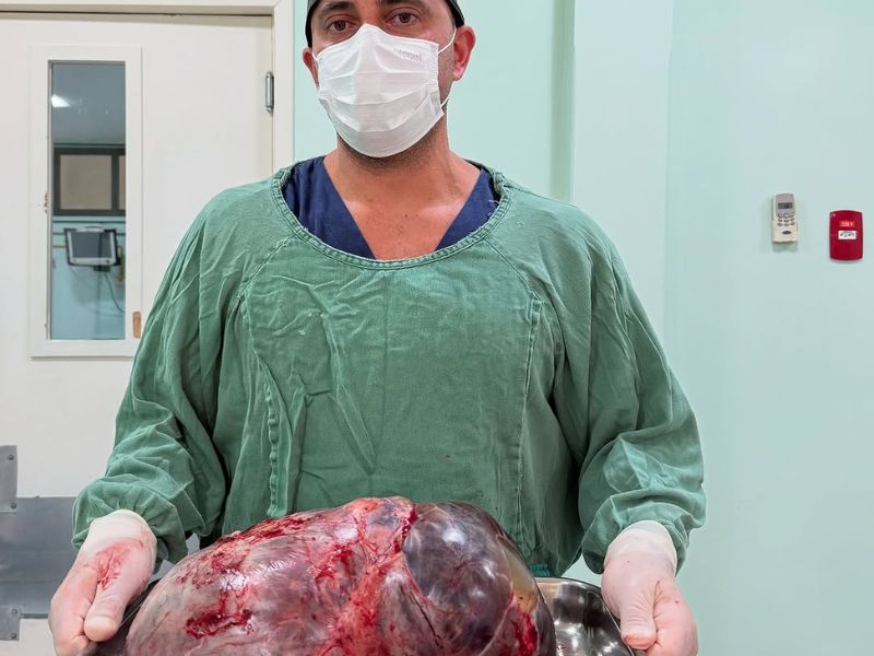 Mulher de Rio das Ostras tem tumor de quase 15kg retirado em cirurgia na Região Serrana