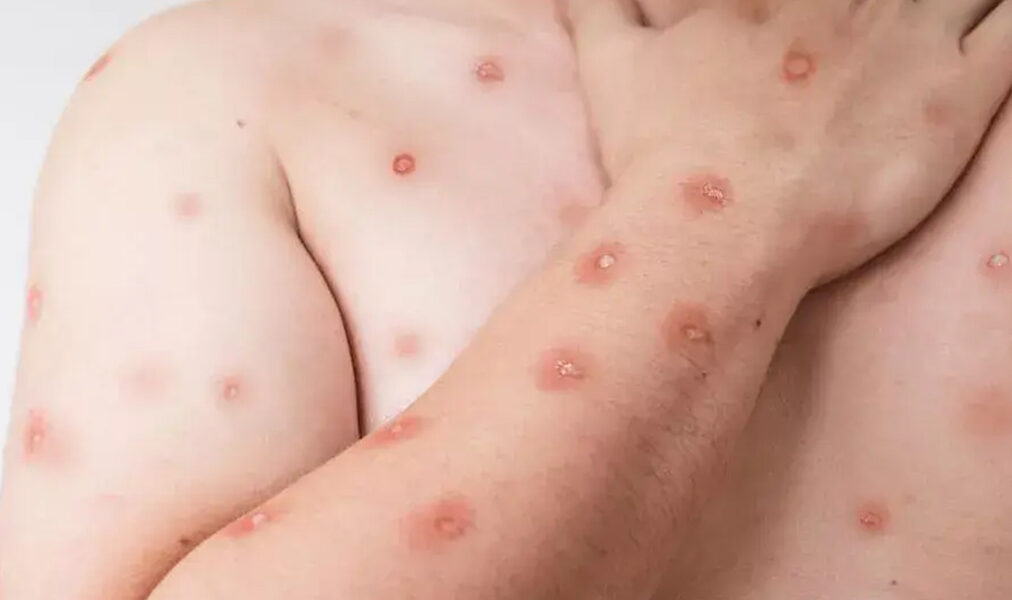 Secretaria de Saúde de Araruama orienta população sobre sintomas e prevenção da mpox